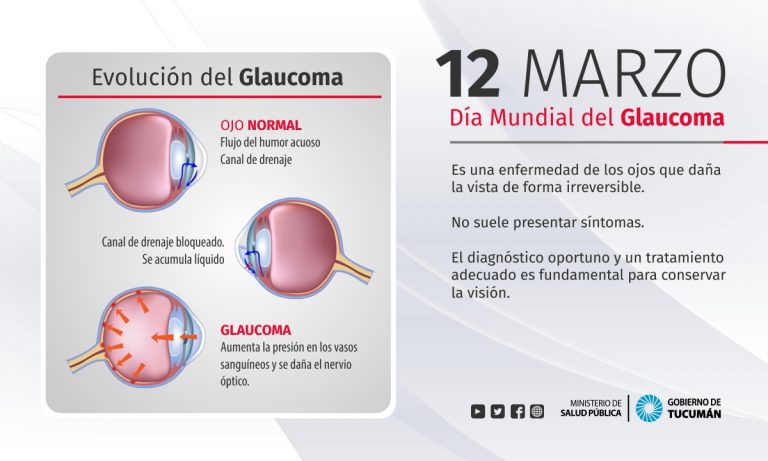 Se Conmemora El Día Mundial Del Glaucoma La Segunda Causa De Ceguera Ministerio De Salud 4205