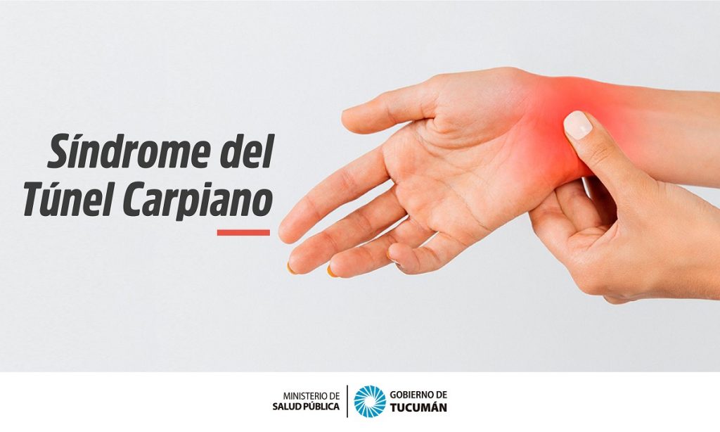 Qué es el síndrome del túnel carpiano y cómo tratarlo - Ministerio de Salud  Pública de Tucumán