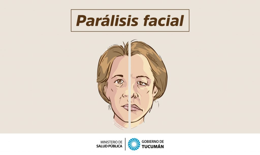 Parálisis Facial: Cuáles son sus tipos y cómo deben tratarse