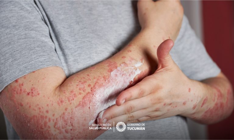 Psoriasis Importancia De Un Diagnóstico Y Tratamiento Oportuno