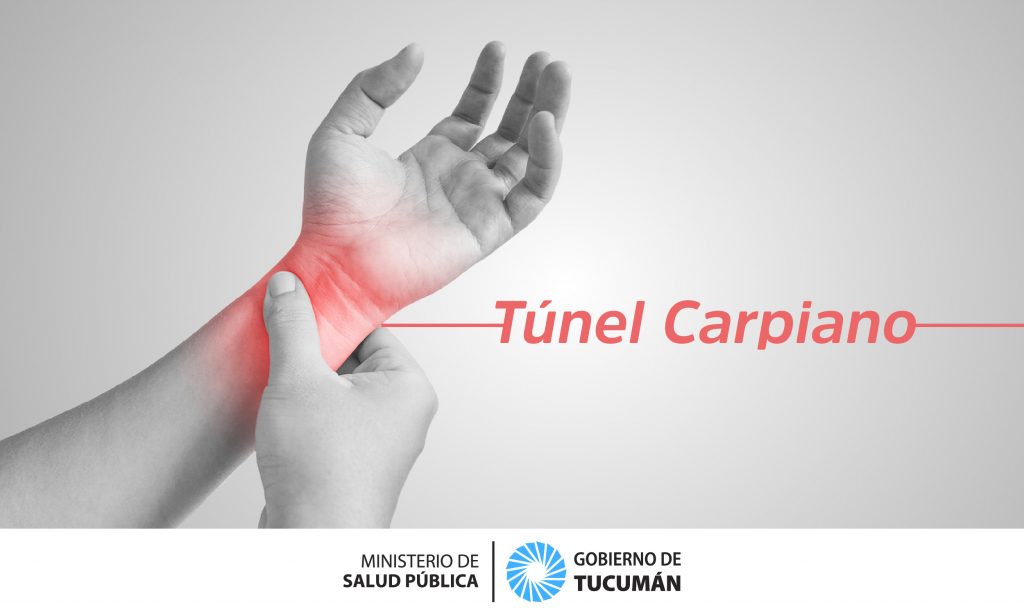 Síndrome del túnel carpiano  Diagnóstico y tratamiento para fisioterapeutas