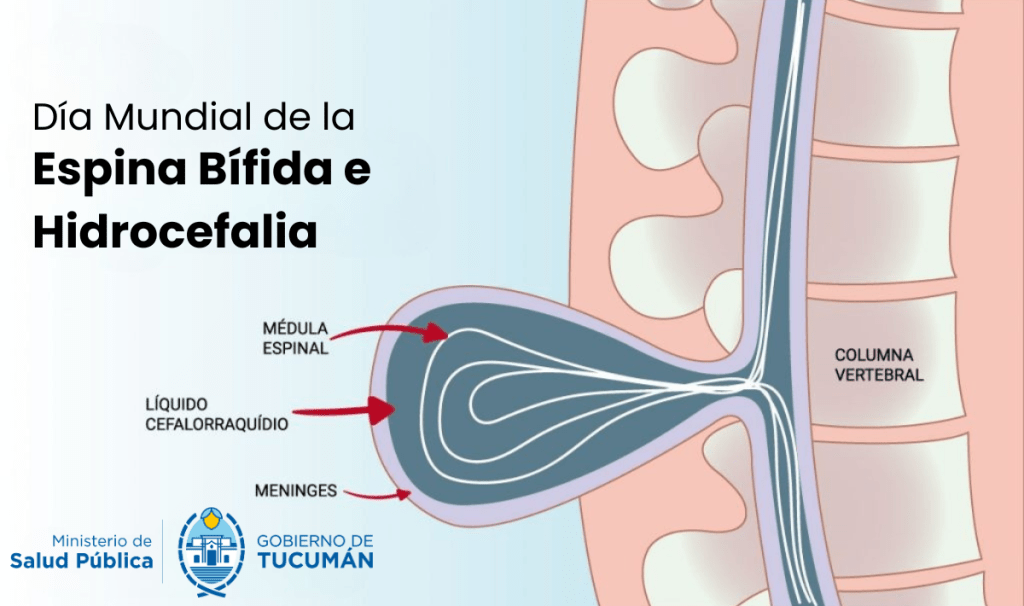 Día Mundial de la Espina Bífida e Hidrocefalia Día Mundial de la Espina Bífida e Hidrocefalia